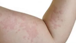 蕁麻疹就是因為習慣才長的！