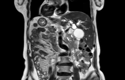 老人罹患膽管癌還是罕見「鏡面人」！他們迎難而上精準「拆彈」！