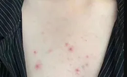 為什麽有些人後背長痘痘，是體質問題嗎？