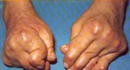 RAI | 類風濕關節炎前沿進展