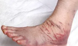 揭秘踝關節扭傷後的