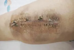 骨關節損傷後出現功能障礙？運動治療讓你的關節「活」起來