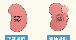 分享3味中藥，治療腎囊腫時發揮大作用！