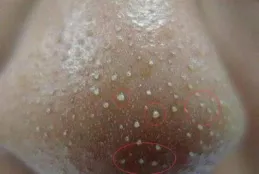 黑頭大到直接擠出來是什麽感受？