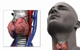 頭頂的「蘑菇」，竟然是甲狀腺癌轉移｜世界頭頸腫瘤日