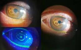 遺忘角落的「隱形危機」！繃帶鏡一年未取，男子視力下降至0.02！