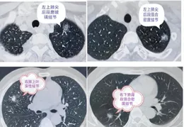长沙市第四医院提醒您：查出肺结节不要慌，早诊早治是关键！
