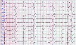 心裏總是「咯噔」一下？一篇文章帶你科學認識「室性早搏」