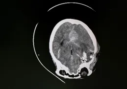 60歲阿姨突發腦動脈瘤破裂，「一站式」復合手術成功搶救