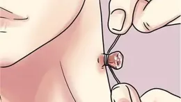 脖子、腋下莫名長出的「小肉粒」，是HPV感染？千萬別摳！