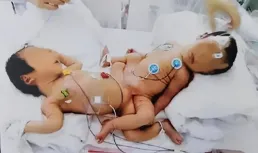 連體人該如何結婚生子？邦克兄弟娶親姐妹花，生下22個孩子