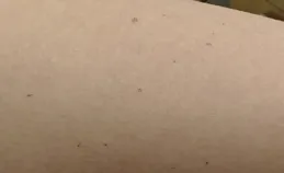 身上突然冒出来的小红点，到底是啥？要不要紧？这篇文章告诉你