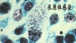 黴漿菌、衣原體對懷孕的「破壞力」