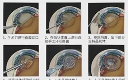 當高度近視遇見白內障，飛秒「無刀」技術助其重獲新生