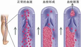 踝泵運動小指南