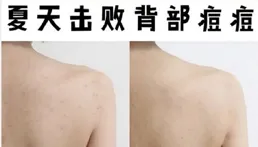 為什麽有些人後背長痘痘，是體質問題嗎？