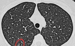 經常生氣真的會長結節嗎？真相來了→