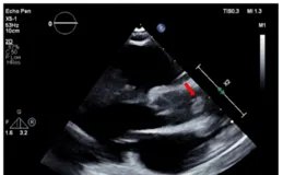 12歲患兒嘔吐，後突發心梗、行心臟移植！這是怎麽了？