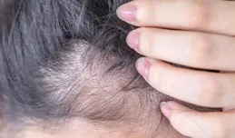 救命！發縫越來越寬，怎麽辦？這種情況要趕緊治療