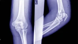 骨折了最好就躺著休息？