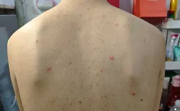 為什麽有些人後背長痘痘，是體質問題嗎？