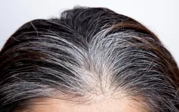 白頭發怎麽治？這些治療白頭發的實用方法快試試