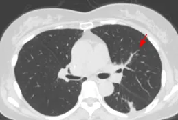 1cm肺磨玻璃結節就要切除肺葉？打破認知：肺泡內腫瘤組織完全消融！