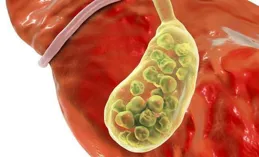 膽囊息肉癥狀有哪些？提前知曉膽囊息肉的癥狀