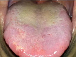 五臟有濕怎麽辦？看看舌頭就知道！教你1招，把身上的濕氣吸幹凈