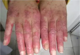 紅斑狼瘡癢嗎？關於紅斑狼瘡這些疑問全解答