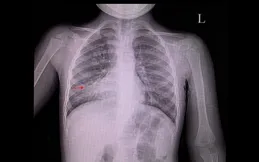 右胸疼是什麽原因？多因素分析