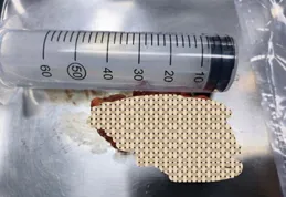 不明原因的體重猛增、血壓升高？警惕「庫欣症候群」！