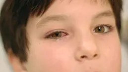 孩子頻繁揉眼睛 警惕過敏性眼病