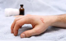 燙傷起水泡怎麽辦？正確處理步驟來了