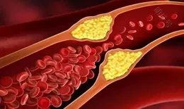 腦血栓是吃出來的？醫生多次強調：若想血管健康，這幾類食物少吃