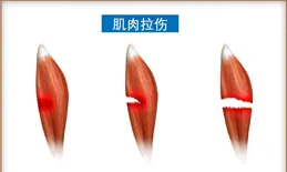 肌肉拉傷是種什麽體驗?