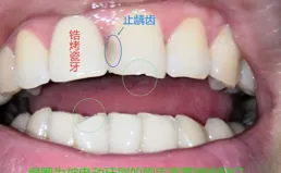 聲波電動牙刷會不會導致牙隱裂？