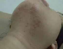 從3%到20%！脖子裏的「小疙瘩」為何越查越多？