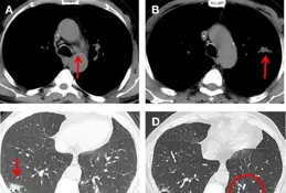 CD38單抗破局，如何重塑多發性骨髓瘤治療版圖？｜21CC腫瘤周
