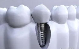 假牙修復醫院怎麽選靠譜嗎