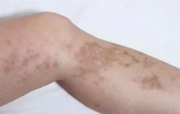 春季易過敏！出現這4種癥狀需警惕，醫生提醒：這樣做或可預防