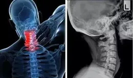 頸椎和腰椎不好可以練三大項嗎?