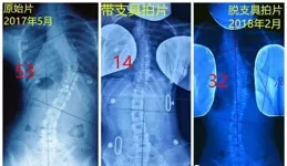 讓孩子遠離脊柱側彎