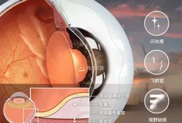 高度近視能進行跳繩運動嗎？