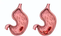 「胃」，你好嗎？日常養胃要避開這些誤區
