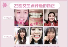 隱適美牙套清潔方法有哪些？