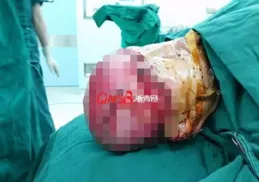 一塊辣椒皮惹禍！浙江男子高燒40℃，肺部大片感染！醫生提醒這個動作很危險