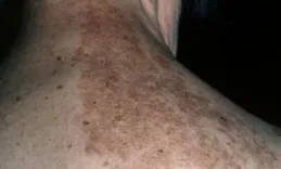 「皰」影｜帶狀皰疹為何成慢病老人「不能承受之痛」？