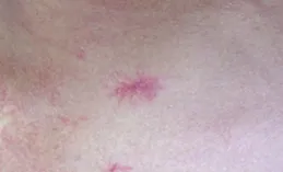 以為是濕疹，結果竟是癌！醫生：很多患者去錯科室