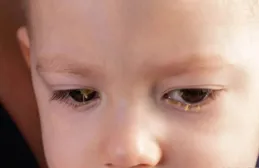 千萬不要大意！早上起床「眼屎」增多，當心是這些眼病！